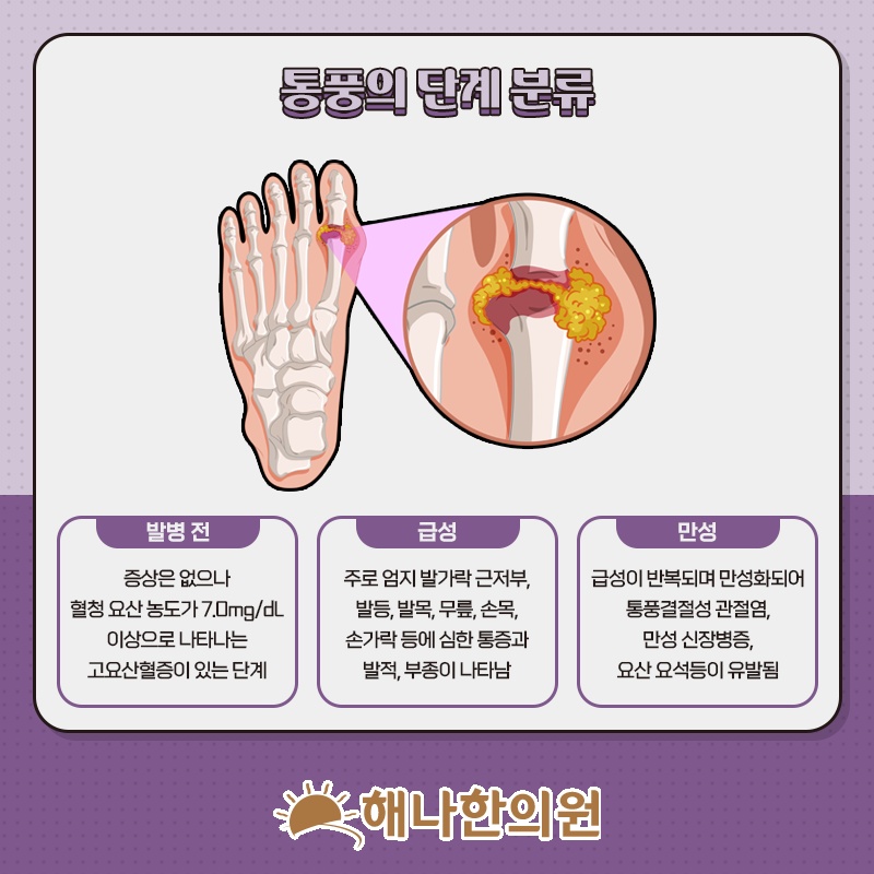 요산 결정이 관절에 쌓여 나타나는 통풍의 변화