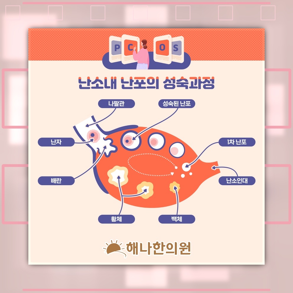 다낭성난소증후군에서 호르몬 균형을 돕는 생활 점검