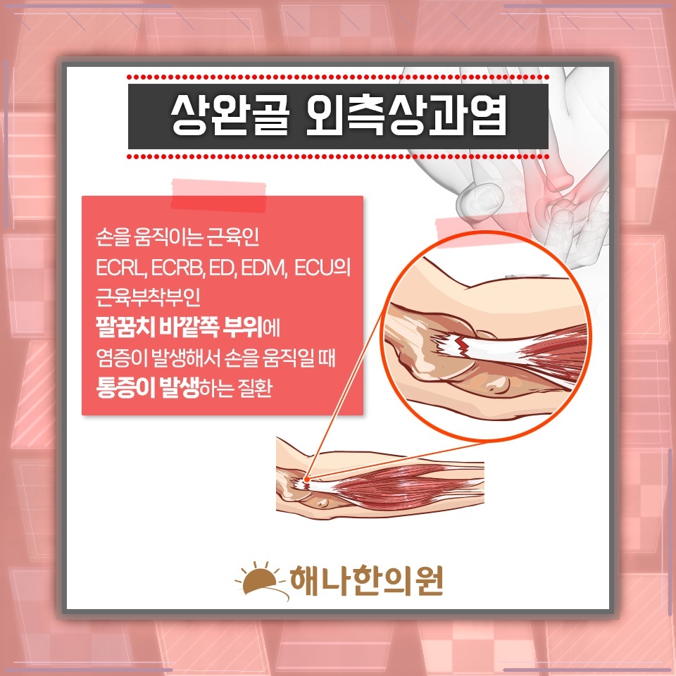 반복되는 팔 사용 뒤 나타난 테니스엘보 팔꿈치 통증