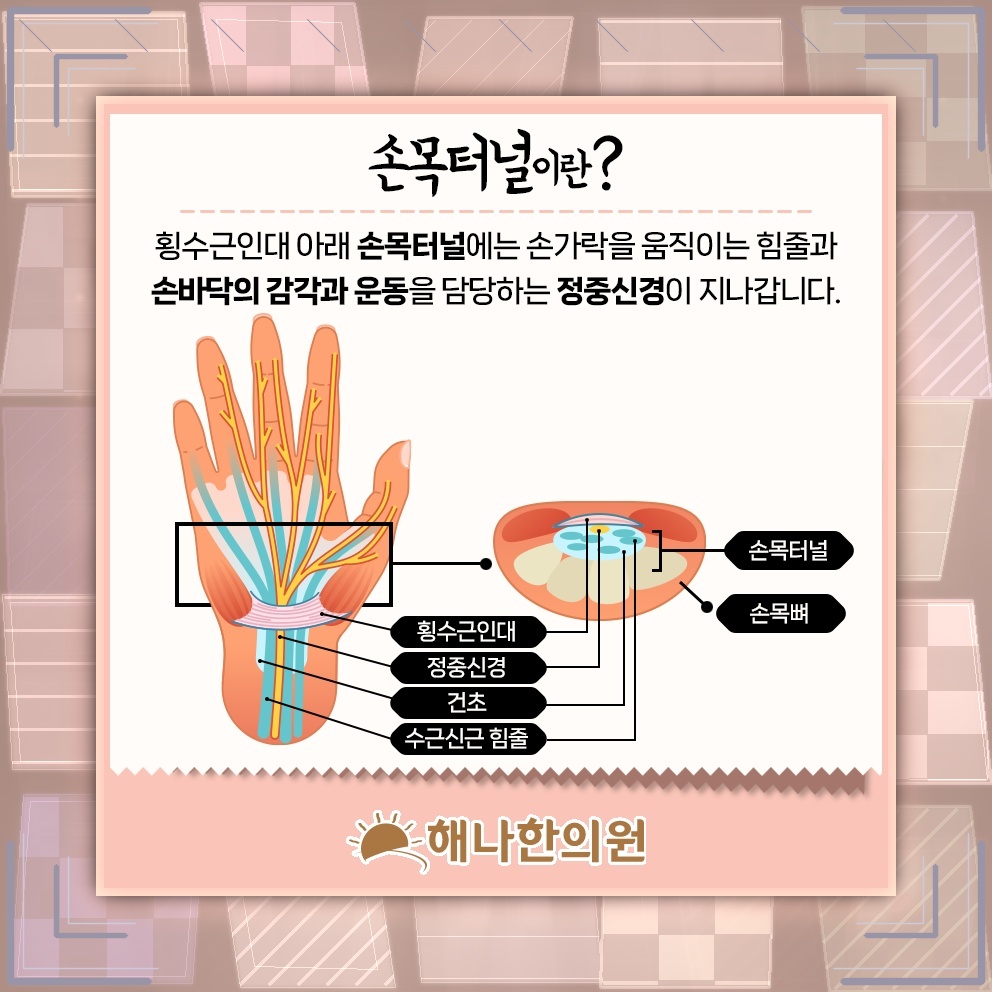 손목터널증후군 초기 증상, 비절개 치료를 살펴볼 때