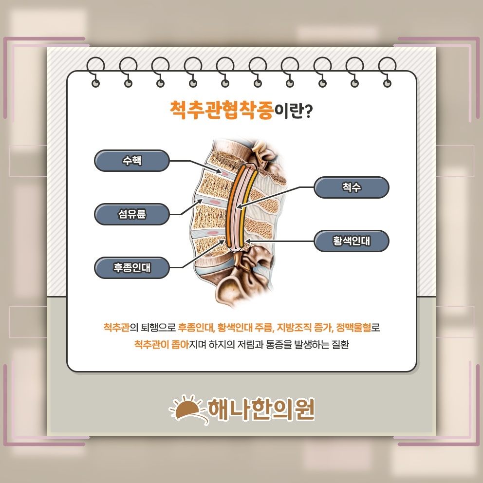 다리 저림과 힘 저하로 나타나는 척추관협착증 신경 증상