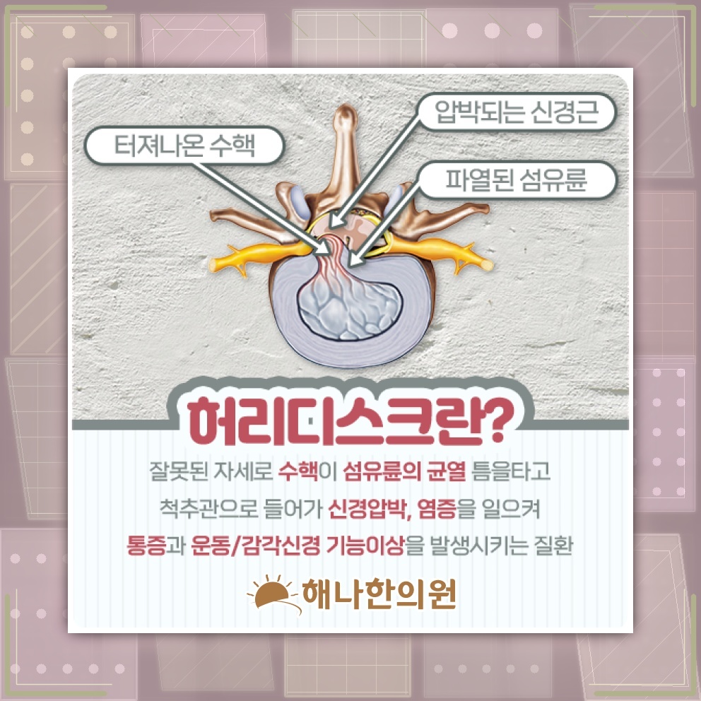 허리디스크로 이어지는 허리 통증과 다리 저림의 양상
