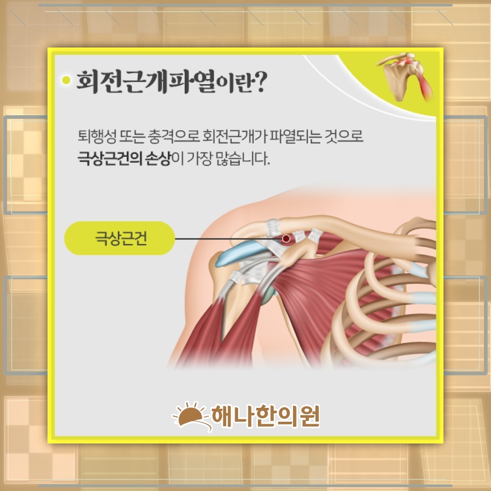 회전근개파열 이후 어깨 통증이 심해지는 과정