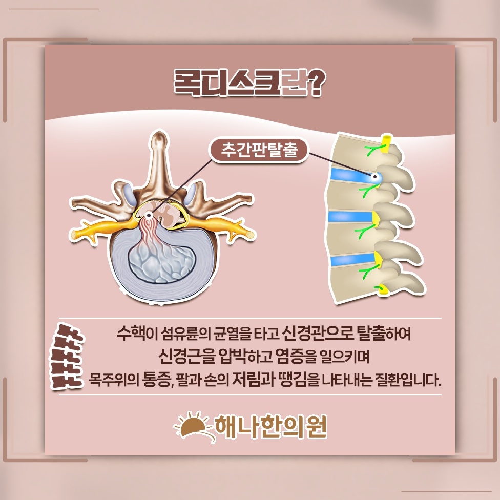 목디스크와 경추 정렬, 본래 자리에서 달라지는 변화